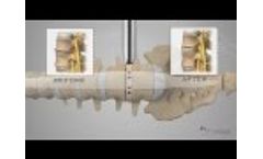 NuVasive® XLIF® Patient Animation - Video
