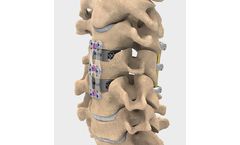 NuVasive - Model ACDF - Anterior Cervical Plate (ACP) System