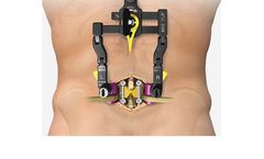 NuVasive - Model MAS Midline - Posterior