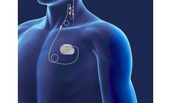 VNS Therapy - Vagus Nerve Stimulation Therapy for Difficult to Treat Depression