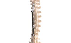 ApiFix - Model MID-C - Adolescent Idiopathic Scoliosis (AIS)
