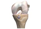 OrthoPediatrics - Model ACL - Anterior Cruciate Ligament Reconstruction System