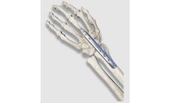 OrthoPediatrics PediFrag - Wrist Fusion System