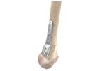 OrthoPediatrics - Distal Femoral Osteotomy System (DFOS)