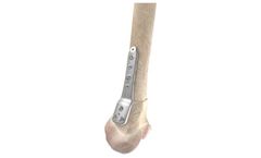 OrthoPediatrics - Distal Femoral Osteotomy System (DFOS)