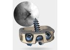 Stalif - Model M Ti - No-Profile Anterior Lumbar Integrated Interbody System