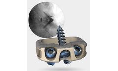 Stalif - Model M Ti - No-Profile Anterior Lumbar Integrated Interbody System