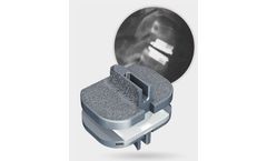 Prodisc - Model C - Anterior Cervical Total Disc Replacement