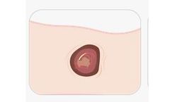 MaxioCel - Highly Absorbent Wound Dressing