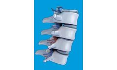 Neo - Degenerative Disc Disease (DDD)