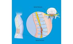 Neo - Spinal Stenosis