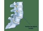 Spondylolisthesis