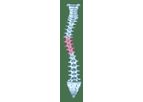Degenerative Scoliosis
