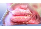 Neuromark - Rhinitis Treatment System