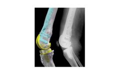 Prophecy - Personalized Knee Solutions