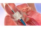 JenaValve - Transcatheter Heart Valve (THV)
