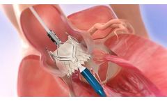 JenaValve - Transcatheter Heart Valve (THV)