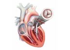 JenaValve - Aortic Valve Regurgitation
