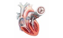 JenaValve - Aortic Valve Regurgitation