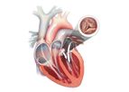 JenaValve - Aortic Valve Stenosis