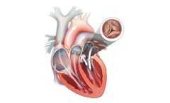 JenaValve - Aortic Valve Stenosis