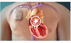 Optimizer - Cardiac Implantable Device