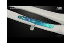 ARIX Ulna Shortening - Video