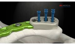 ARIX Clavicle Surgical Guide - Video