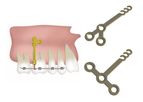 Jeil - Dual Top Anchor System - Orthodontic Anchor Plates
