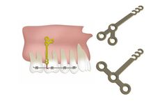 Jeil - Dual Top Anchor System - Orthodontic Anchor Plates