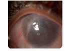 Electrospinning - Cornea Regeneration