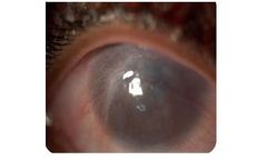 Electrospinning - Cornea Regeneration
