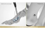 APTUS Foot Hallux System 2 8 Hallux Arthrodesis MTP 1 Fusion - Video