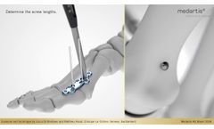 APTUS Foot Hallux System 2 8 Hallux Arthrodesis MTP 1 Fusion - Video