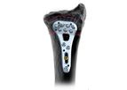 TriLock Adaptive - Model II 2.5, Volar - Distal Radius Plates