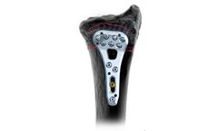 TriLock Adaptive - Model II 2.5, Volar - Distal Radius Plates