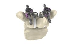 IMPLANET Jazz - Model Cap SP - Posterior Fixation Spine