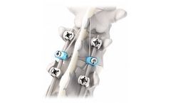 IMPLANET Jazz - Model PF - Degenerative Spine