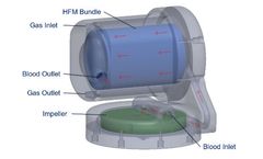 ALung Announces Commercial Development of its Breakthrough Next Generation Artificial Lung