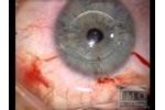 ARTIFLEX implantation by Dr J.L. Güell - Video