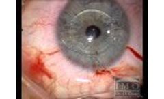 ARTIFLEX implantation by Dr J.L. Güell - Video