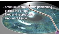 VacuFix vacuum enclavation system by OPHTEC - Video