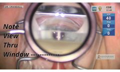 Ocular Ahmed DVX Alignment - Video