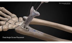 Osteomed ExtremiLOCK Wrist video