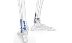 Acumed - Model 3 - Ankle Plating Fixation System