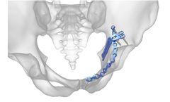 Acumed - Pelvic Plating System