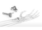 Acumed - OsteoMed ExtremiLock Wrist Plating System