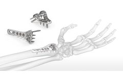 Acumed - OsteoMed ExtremiLock Wrist Plating System