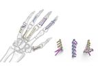 Acumed - Hand Fracture System