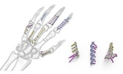 Acumed - Hand Fracture System